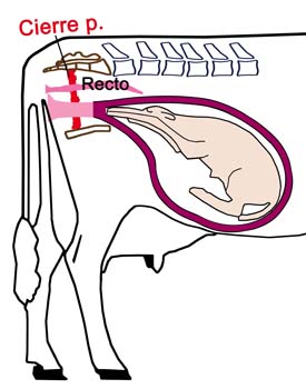3 Cierre pelvis cuad